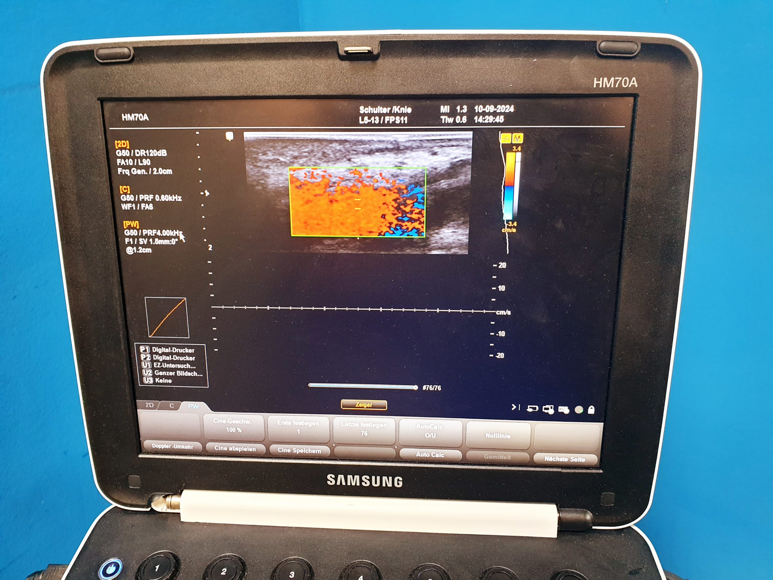 Samsung HM70A + L5-13 Linear Sonde + …. DOM 2015